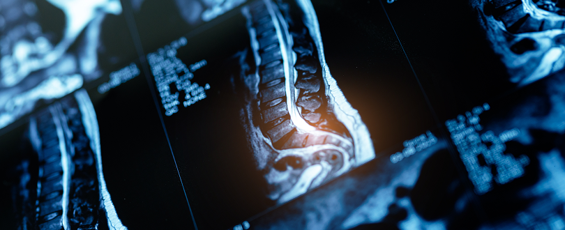 Spinal Cord Injury